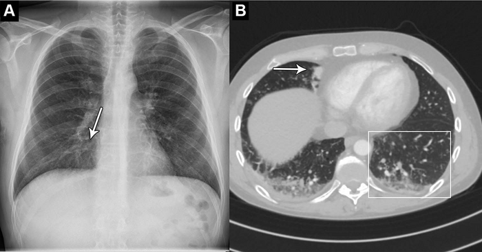 pneumonia chest x ray compared to normal