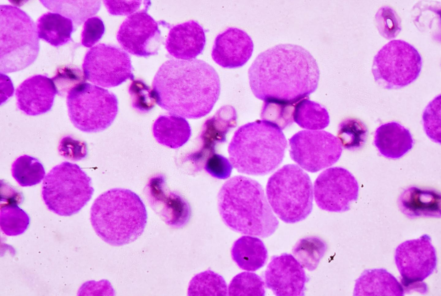 Blood smear under microscopy showing adult acute myeloid leukemia