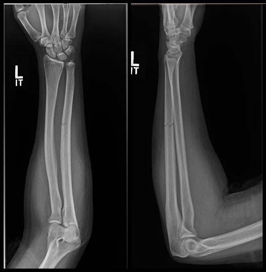 ulna bone fracture