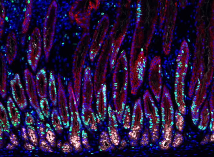 Stomach tissue infected with Helicobacter bacteria