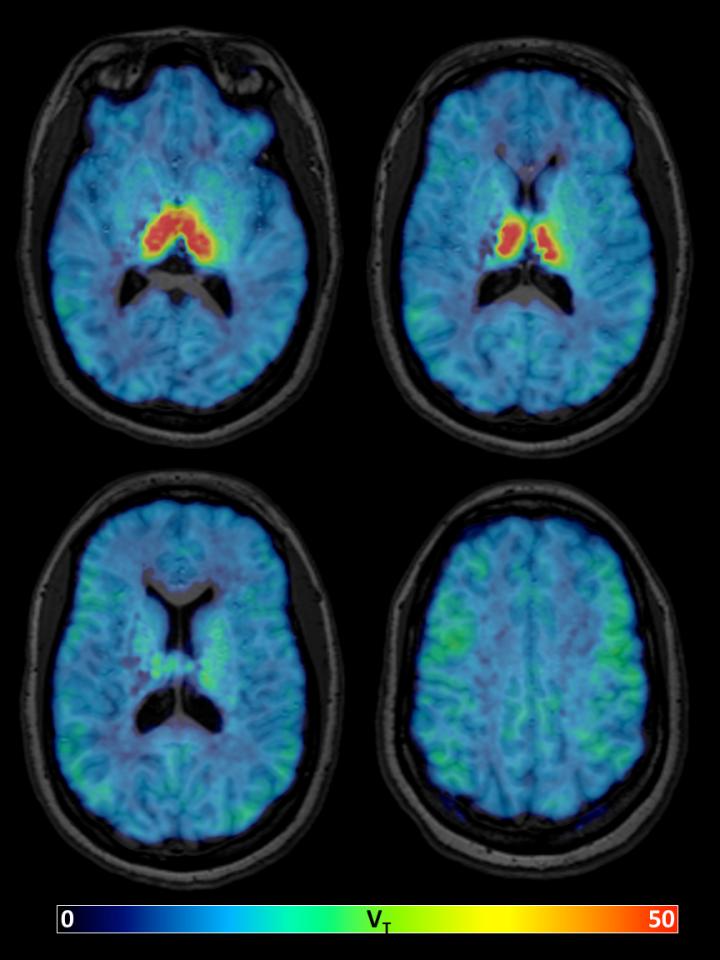 New Nuclear Medicine Tracer Will Help Study the Aging Brain