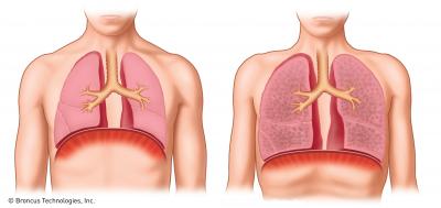 Normal Lungs vs. Emphysema Lungs