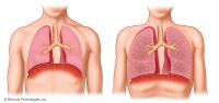 Normal Lungs vs. Emphysema Lungs