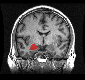 Understanding the molecular interactions that switch the basolateral amygdala into and out of negative network states