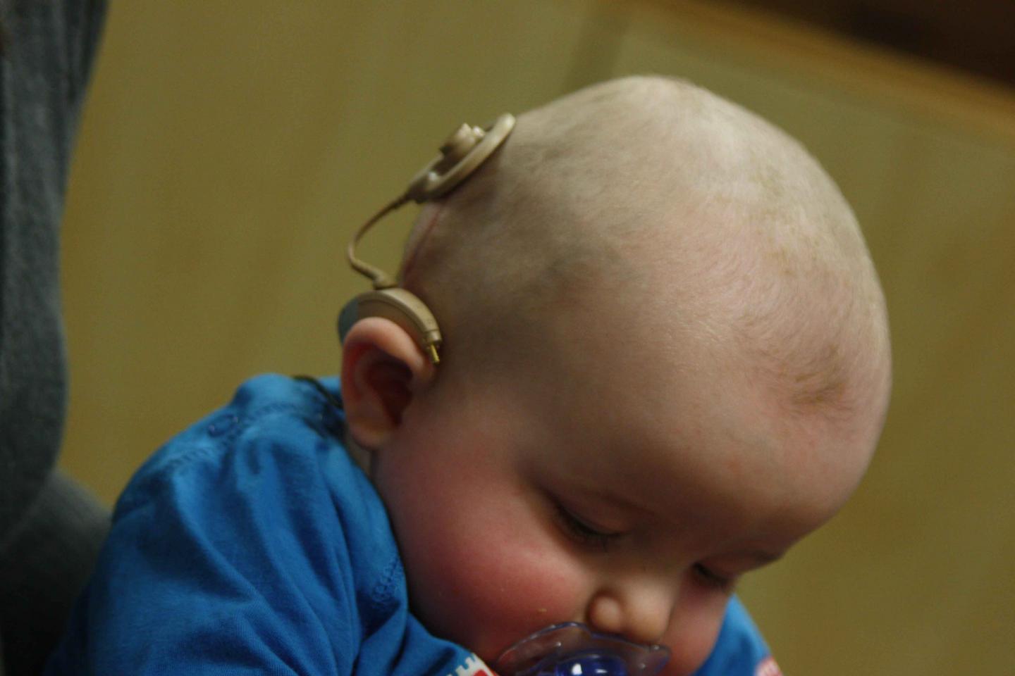 Baby with Cochlear Implant