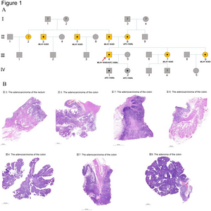 Study Reveals Somatic Mutation Profile of Colorectal Tumor with Simultaneous APC and MLH1 Germline Mutations