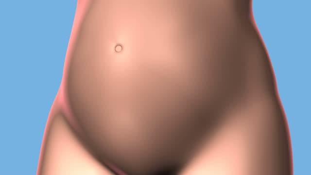 Animation of the in Utero Fetal Surgery to Repair a Spina Bifida Birth Defect