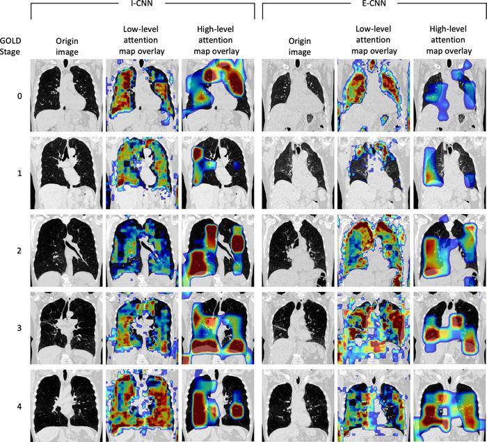 Visualization of attention maps from COPD research