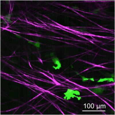 Spread of Pancreatic Cancer Cells