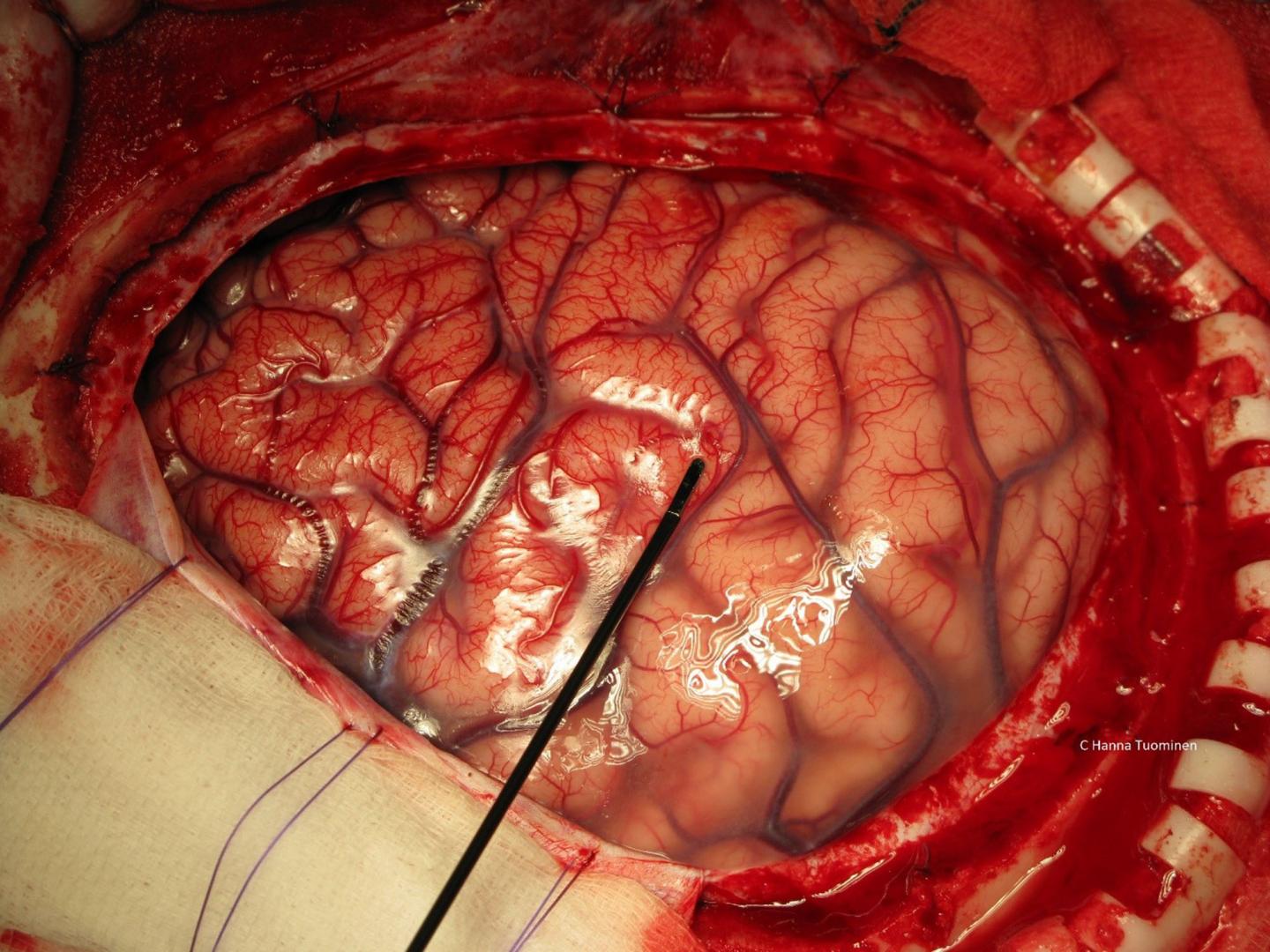 The Surface of the Brain, Pictured During Surgery