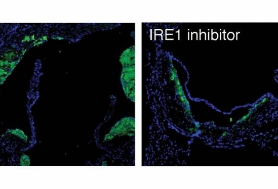 Atherosclerotic Plaques