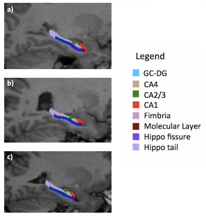 Sub-field of the hippocampus in three young adults