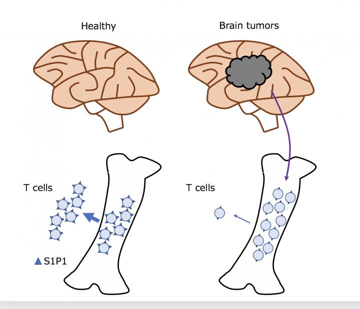 Figure The Level of the T-Cell Surface Protein S1P1 Reduced in Brain Tumor Patients