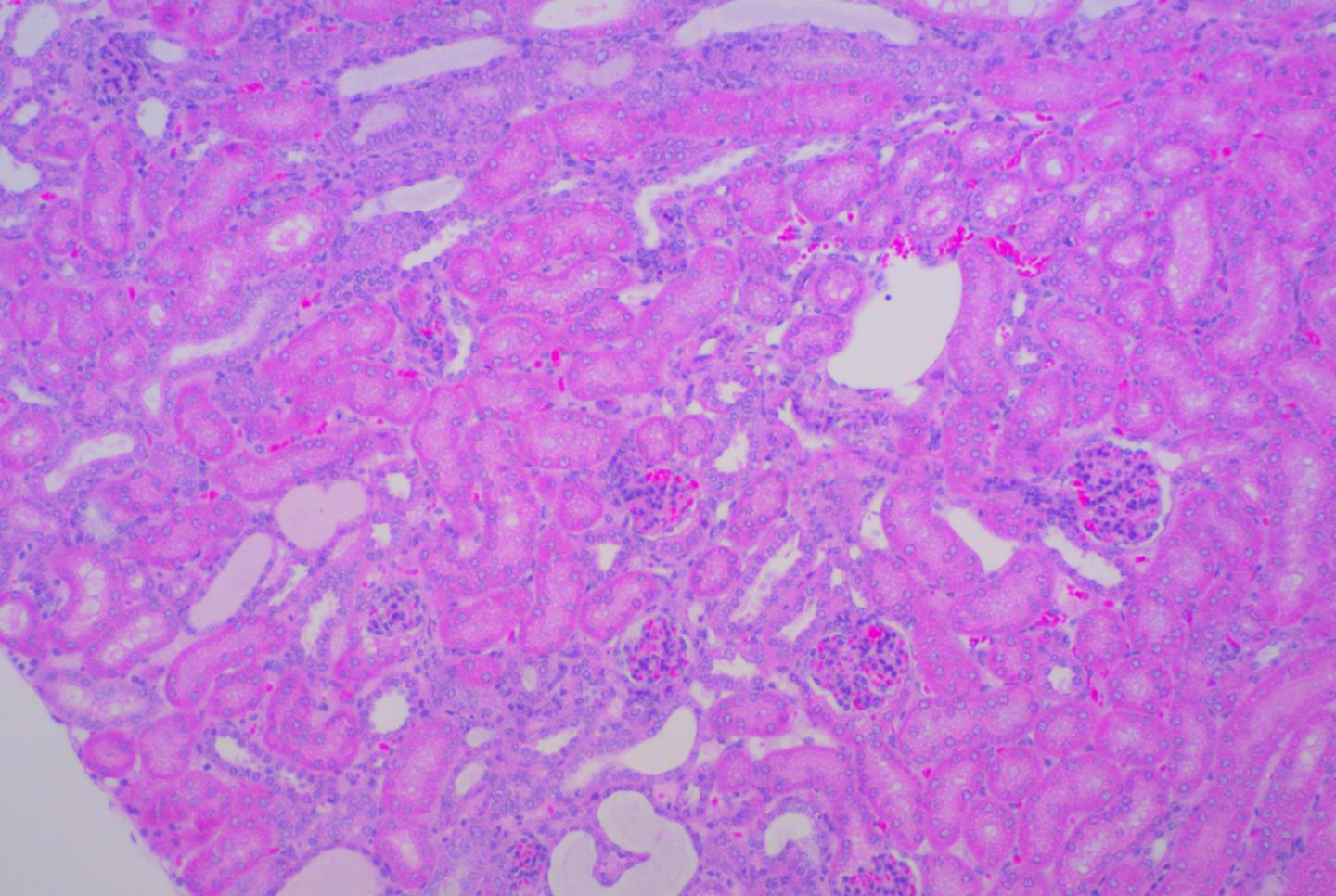 Wnt Secretion Preventing Drugs May Reduce Renal Fibrosis