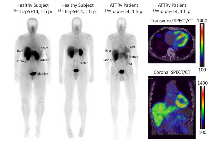 99mTc-p5+14 SPECT/CT imaging of cardiac amyloidosis