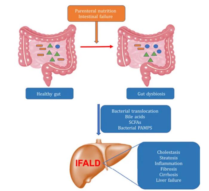 Schematic overview of the role of gut microbiota in the pathogenesis of intestinal failure-associated liver disease (IFALD).