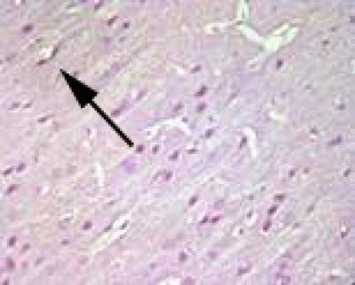 Atorvastatin Pretreatment