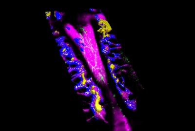Bone Marrow with Leukemia