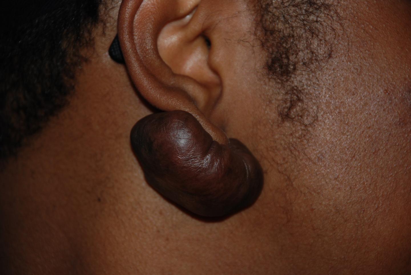 Keloid Scar