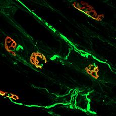 NIH-Funded Rare Disease Network for Myasthenia Gravis