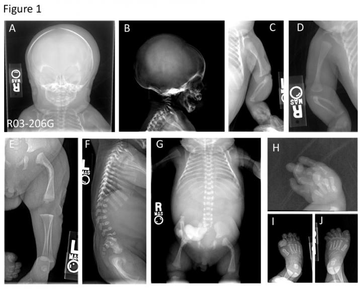 Researchers of the UMA identify a rare genetic bone disorder through massive sequencing methods