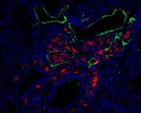 Metastatic Melanoma Cells (Red) in Lymphatic Vessels in Lung (Green)