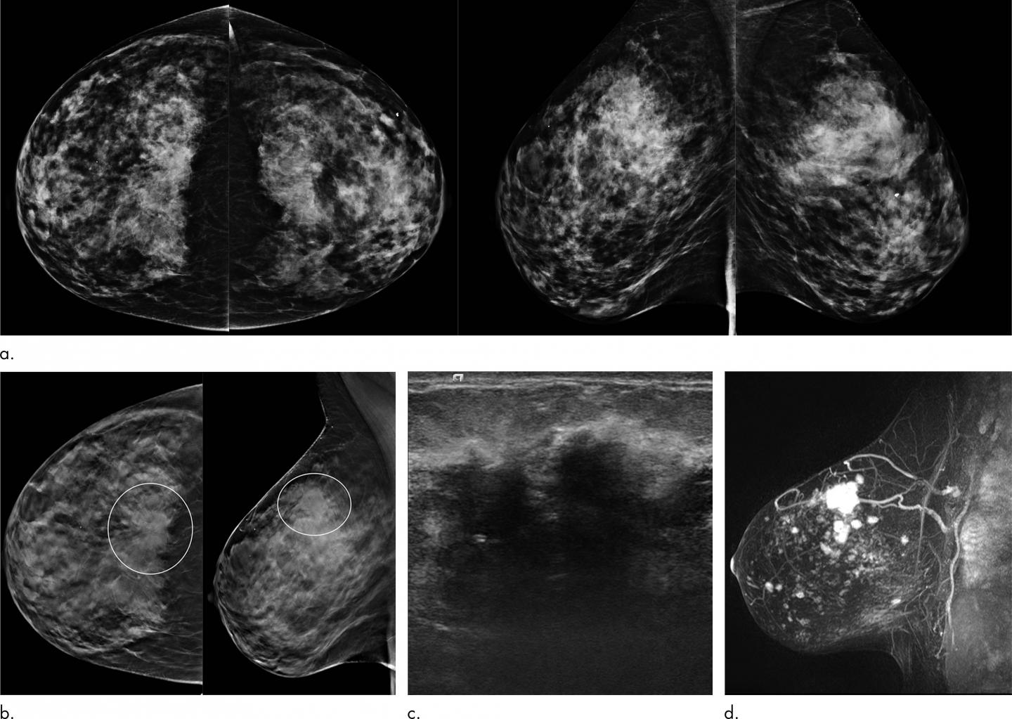 Tomosynthesis Outperforms Digital Mammography in Five-Year Study