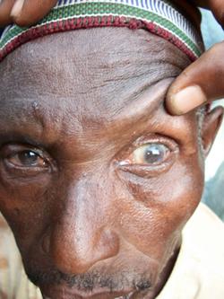 Patient Refusal for Trichiasis Surgery in Tanzania Based Primarily on Misconception of Recovery Time