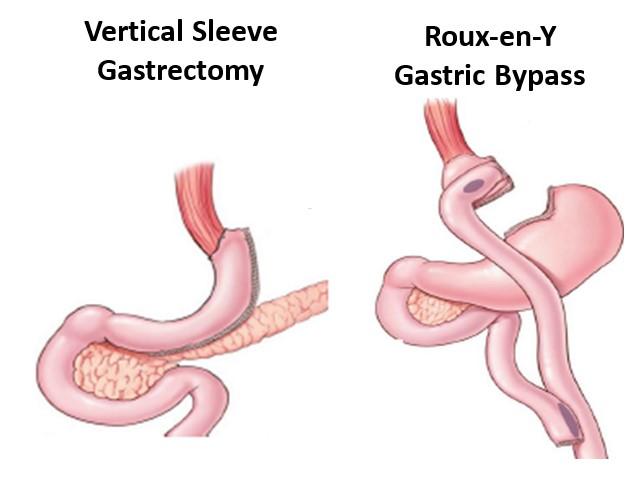 Types of Bariatric Surgery for Teens