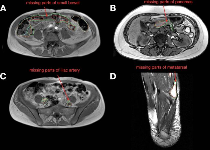 AI Model Automatically Segments MRI Images