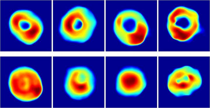 Holographic Microscope Image Showing Differences Between Malaria Infected Cells, Healthy Blood Cells