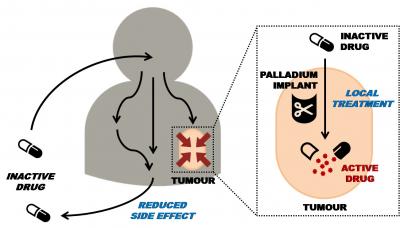 Metal Implants Could Help to Cut Chemotherapy Side Effects, Study Suggests