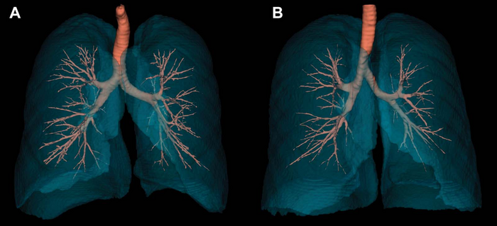 Smaller Airways Increase COPD Risk for Women