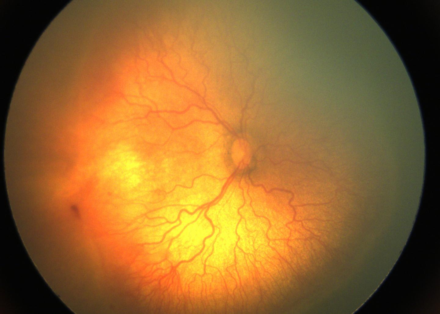 AI Quantifies Fundus Findings