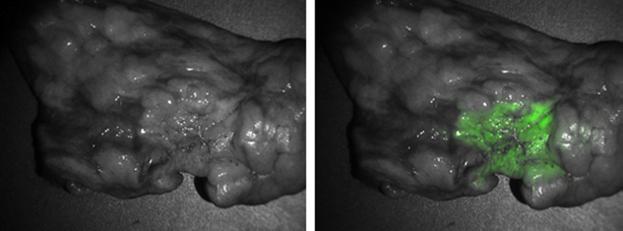Real-Time Imaging of Lung Lesions During Surgery Helps Localize Tumors and Improve Precision