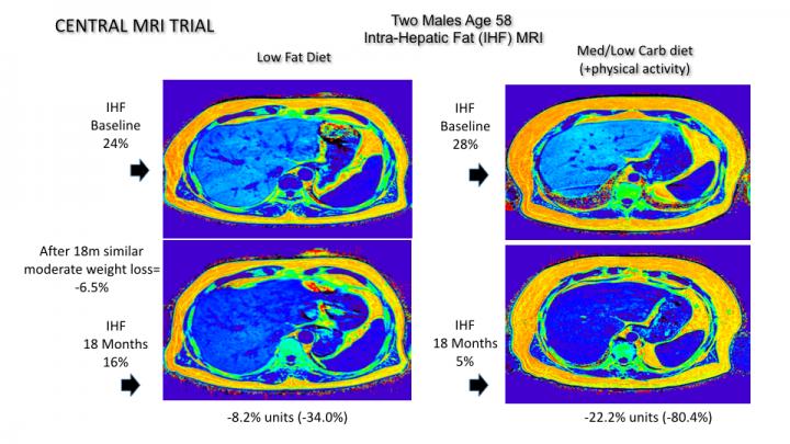 MRI Image Shows Intra-Hepatic Fat Loss Comparison