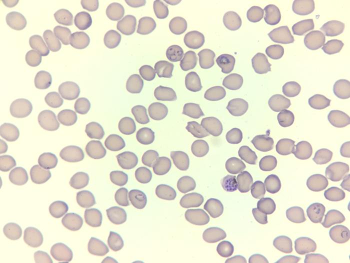 Malaria infected blood