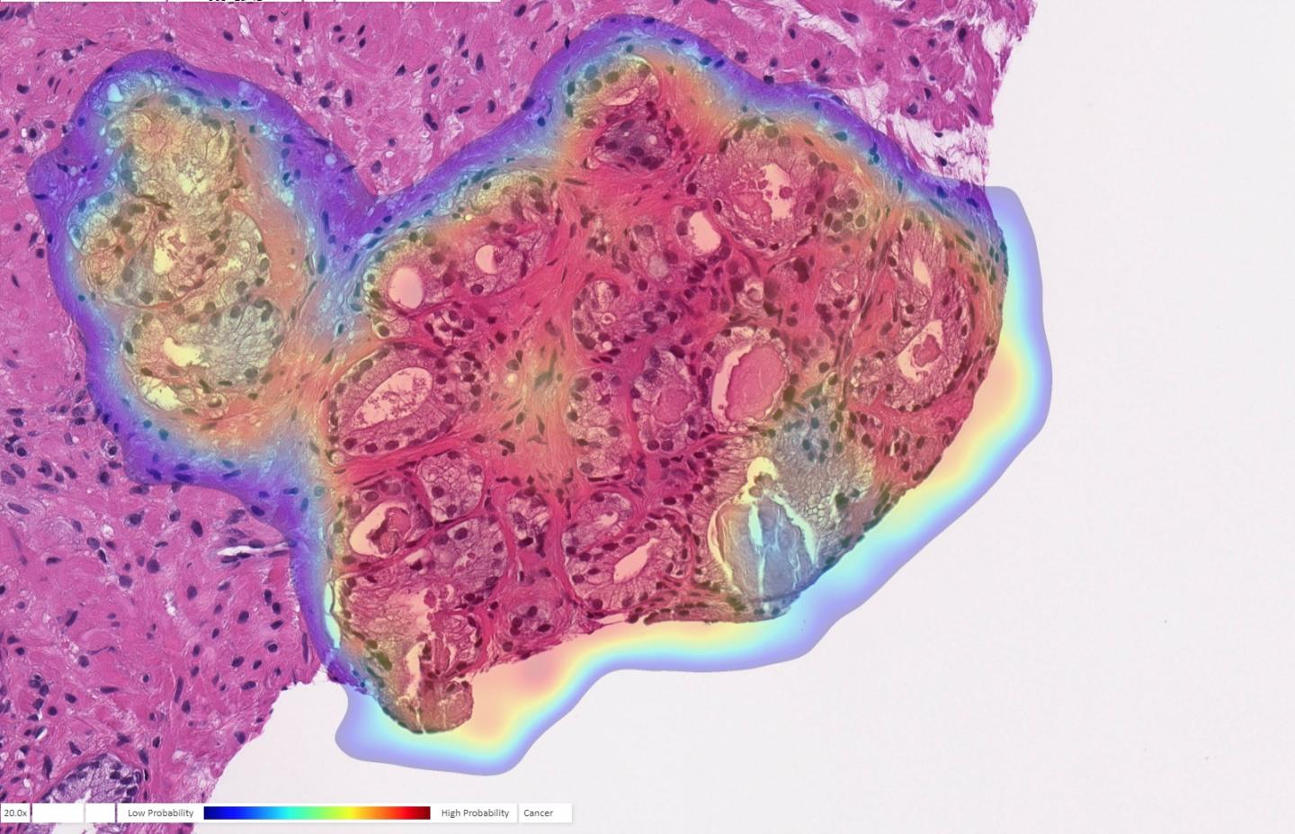 AI Detects Cancer in Prostate Biopsy