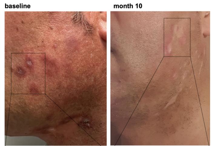 Initial success with skin lupus