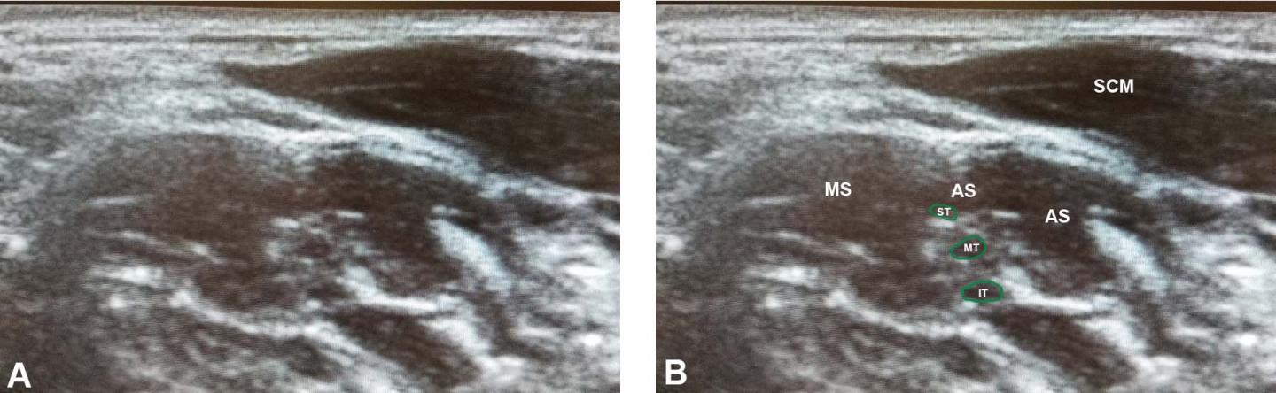 Ultrasound of Newly Identified Variation that Can Predispose Patients to Thoracic Outlet Syndrome