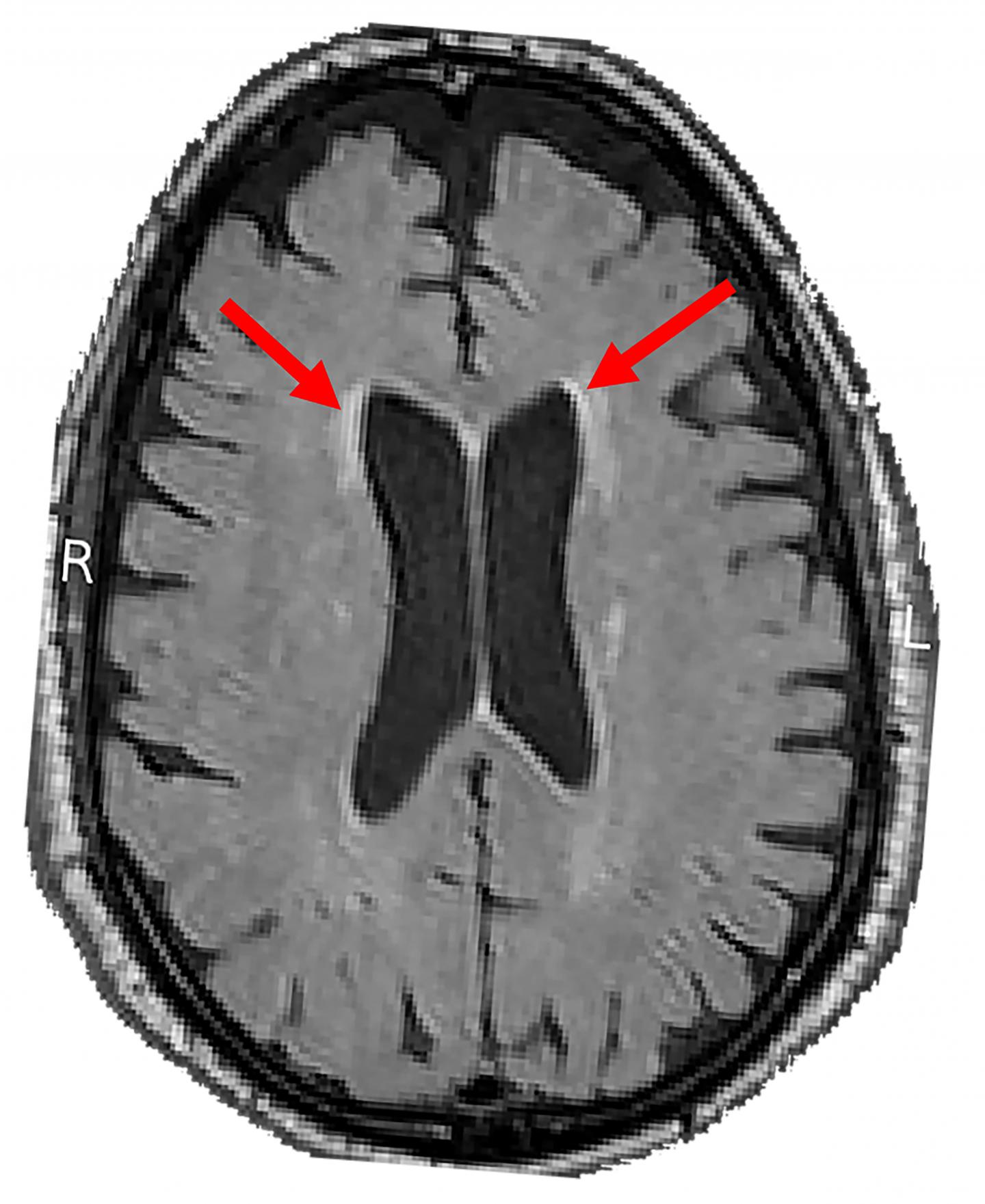 Scanning for White Matter Lesions