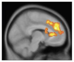 Ketamine Restored Pleasure-Seeking by Boosting aACC Activity