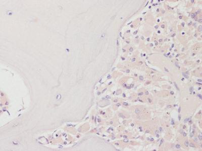 Osteolysis with denosumab treatment