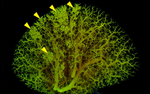 Lung Angiogram