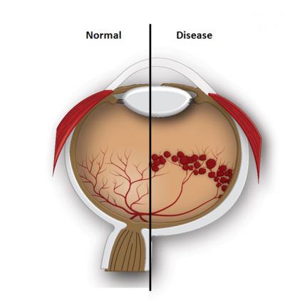 Normal vs. Diseased Retina (schematic)