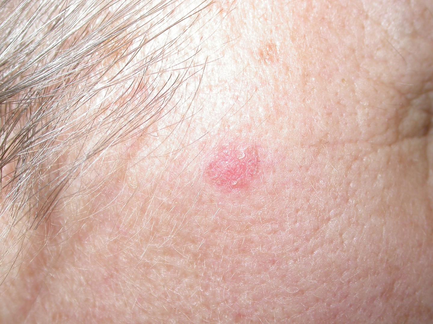 Topical Skin Cream for Treatment of Basal Cell Carcinoma Shows Promise as an Alternative to Surgery