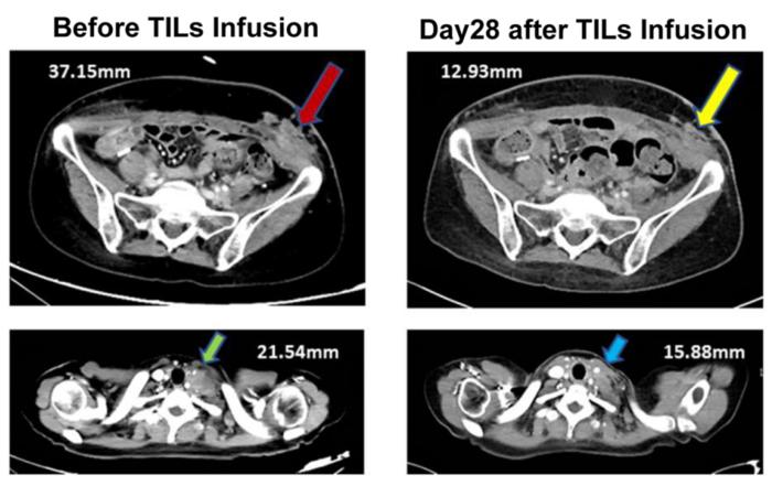 CT scans revealed significant tumor shrinkage within 28 days following the infusion of GT101