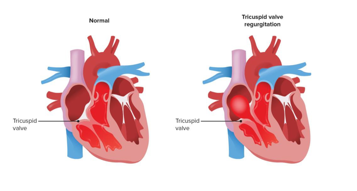 Image 1: Illustrates a normal valve versus tricuspid valve regurgitation