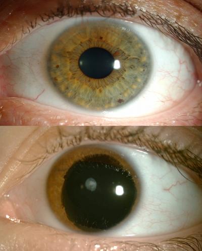 Aniridic Eye