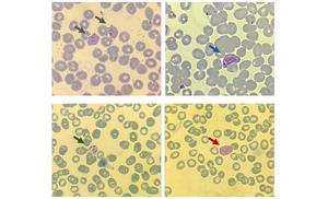 Scientists identify molecules associated with recurrence in blood samples from malaria patients